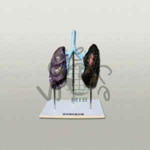 폐의 비교(정상폐와 흡연폐) 폐,폐의비교,정상폐흡연폐